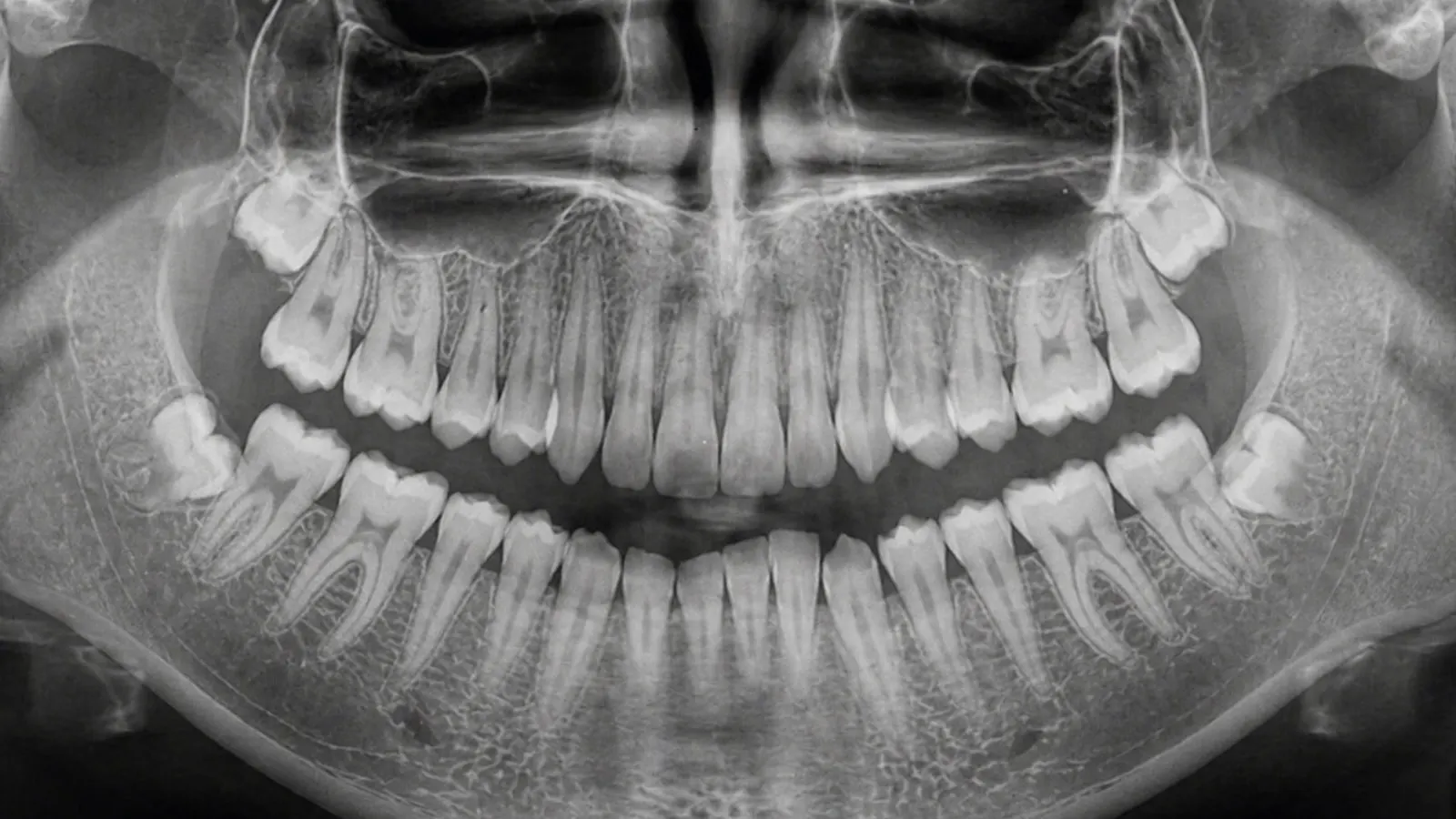 Panoramic X-ray of the dental arches
